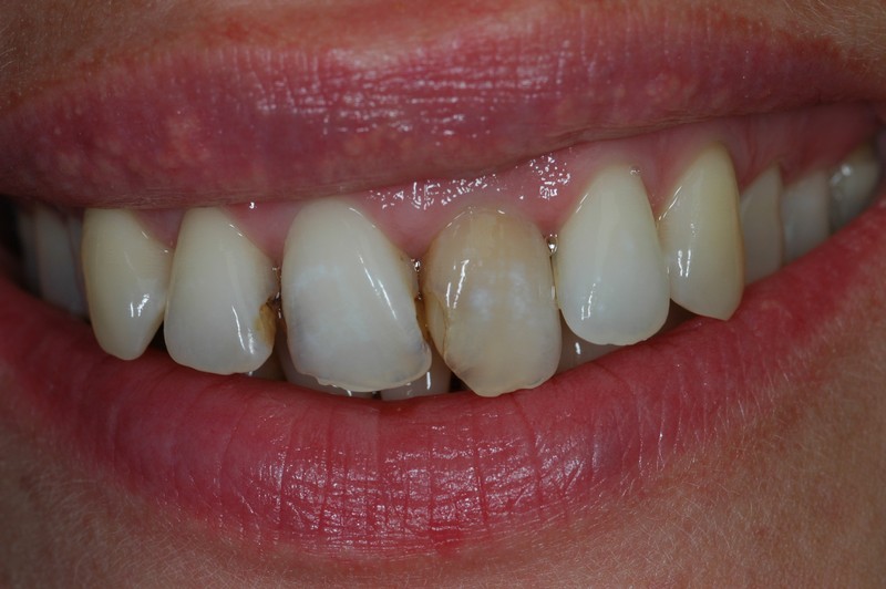 A két leggyakoribb fogbetegség: a fogágybetegség és a fogszuvasodás
