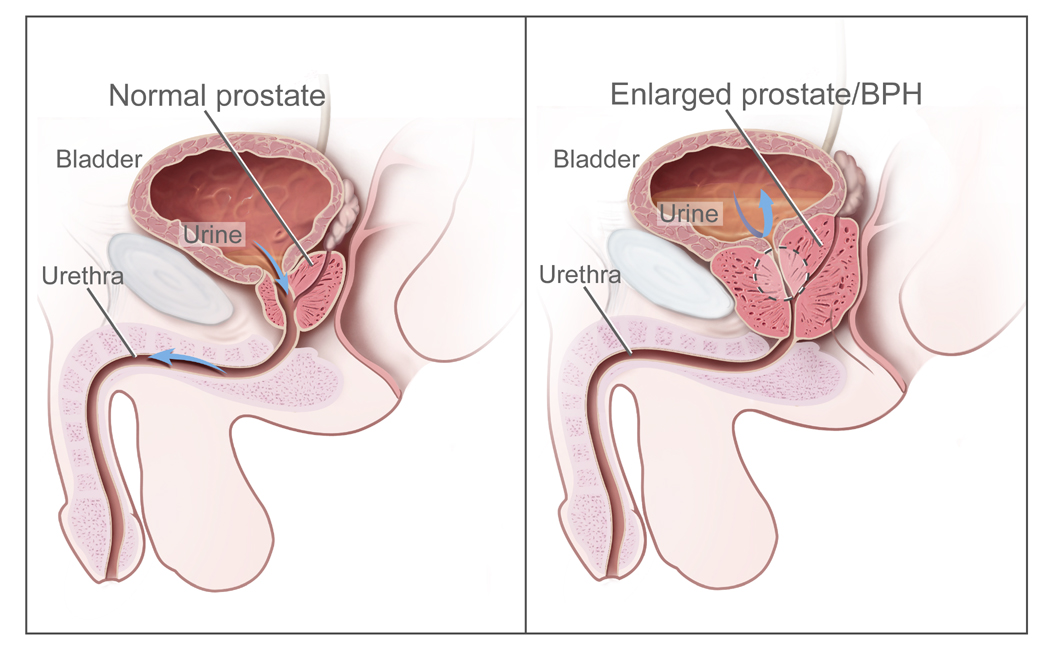a prosztata sérülése nem segített ocnik okar a prostatitis kezelésében
