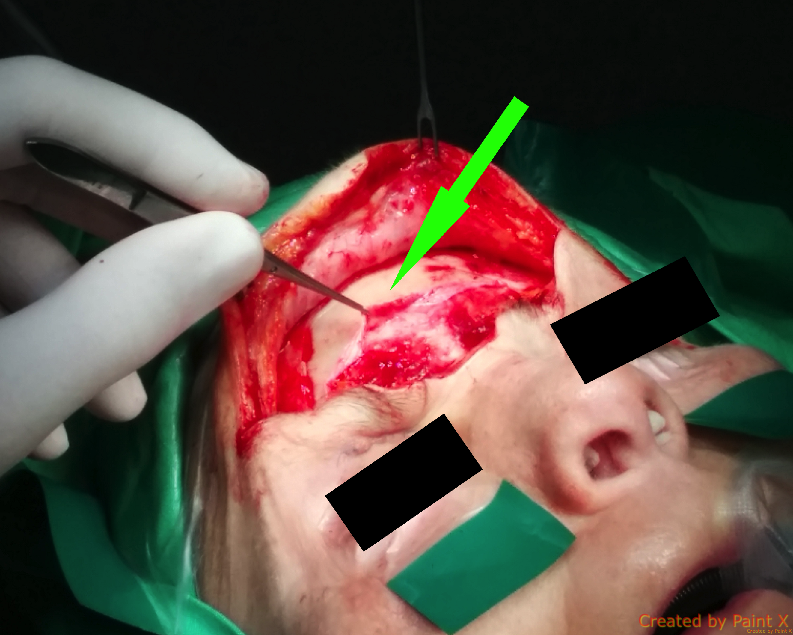 osteoplastic_frontal_sinus_surgery.png