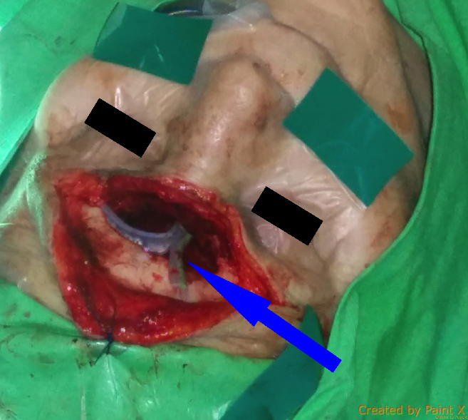 osteoplastic_frontal_sinus_surgery_3.png