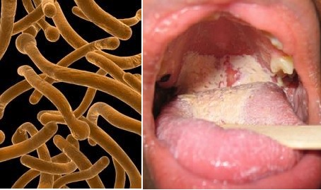 gombás fertőzés a szájban
