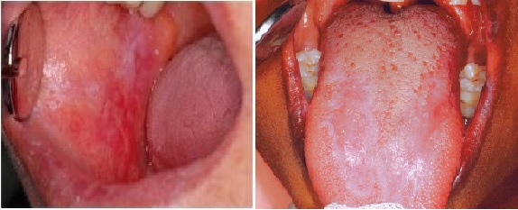 szájpadlás a szájban vörös foltok kezelése)