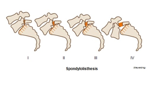 az ágyéki gerinc osteoarthritis a térdízület artrózisa 2 fok