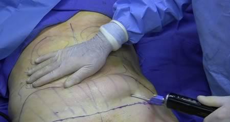 A pénisz plasztikai műtét