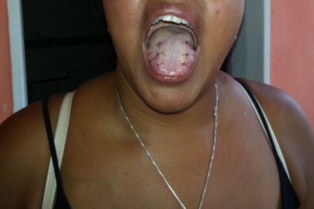 Fogyás a nyelv piercingje után, Nyelv-piercing: lyukasztási és ápolási funkciók