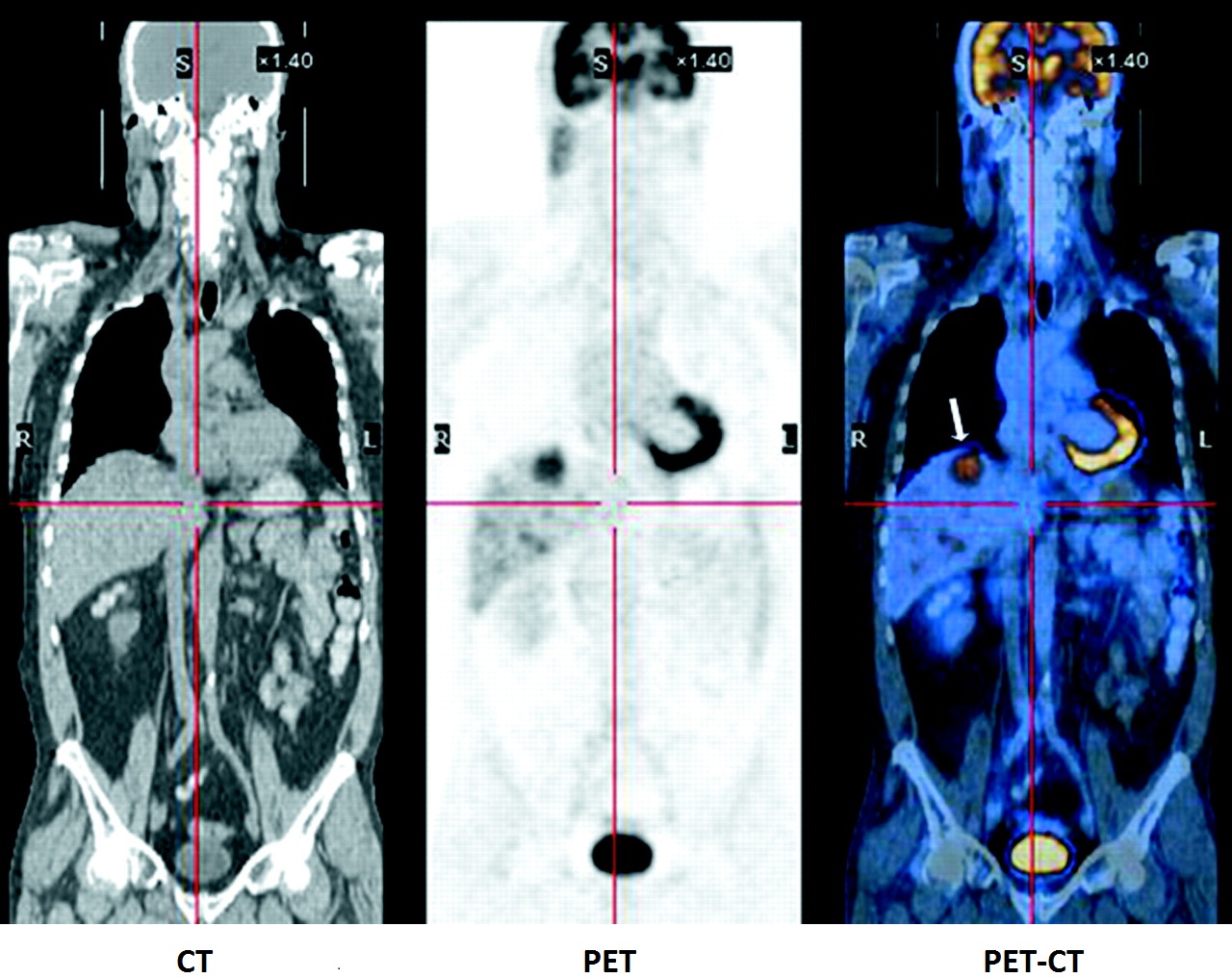 pet ct in oncology ppt