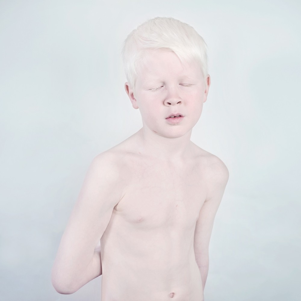 mi az albínók látványa)