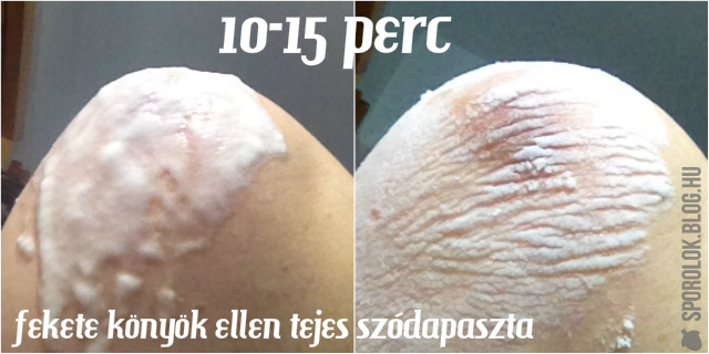 atopic dermatitis nature article a legjobb kenőcsök és krémek pikkelysömörhöz